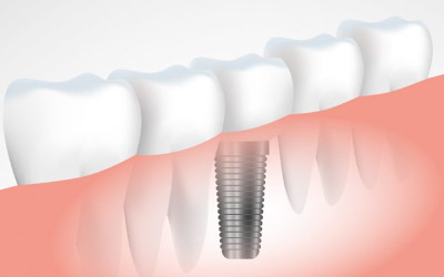 Chronique dentaire: l’implant dentaire, un choix sûr !
