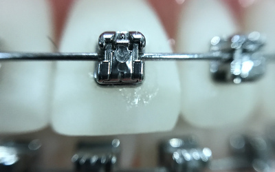 Chronique dentaire: réponses aux questions les plus fréquentes concernant l’orthodontie